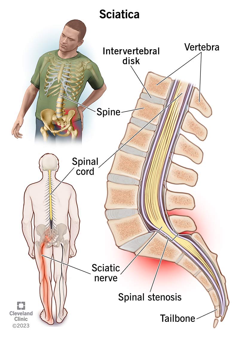 12792-sciatica